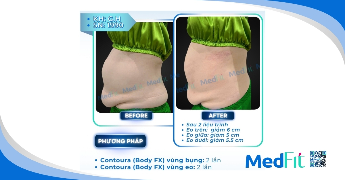 ca lâm sàng giảm mỡ bụng bằng rf contoura tại medfit