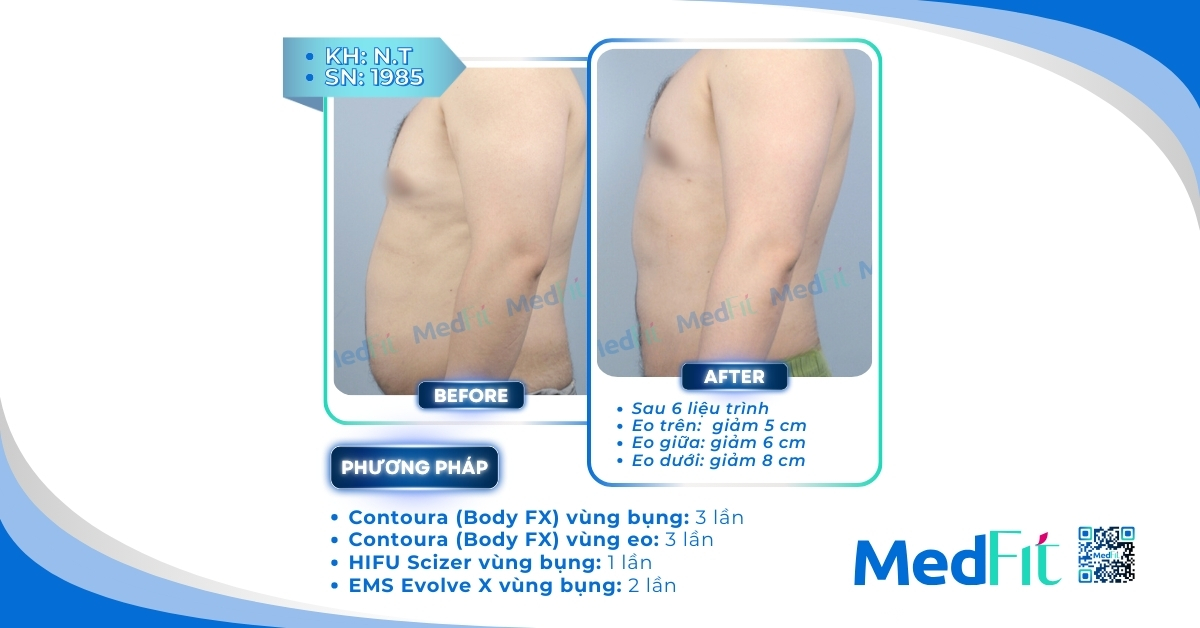 ca lâm sàng giảm mỡ bụng kết hợp scizer và các phương pháp khác tại medfit