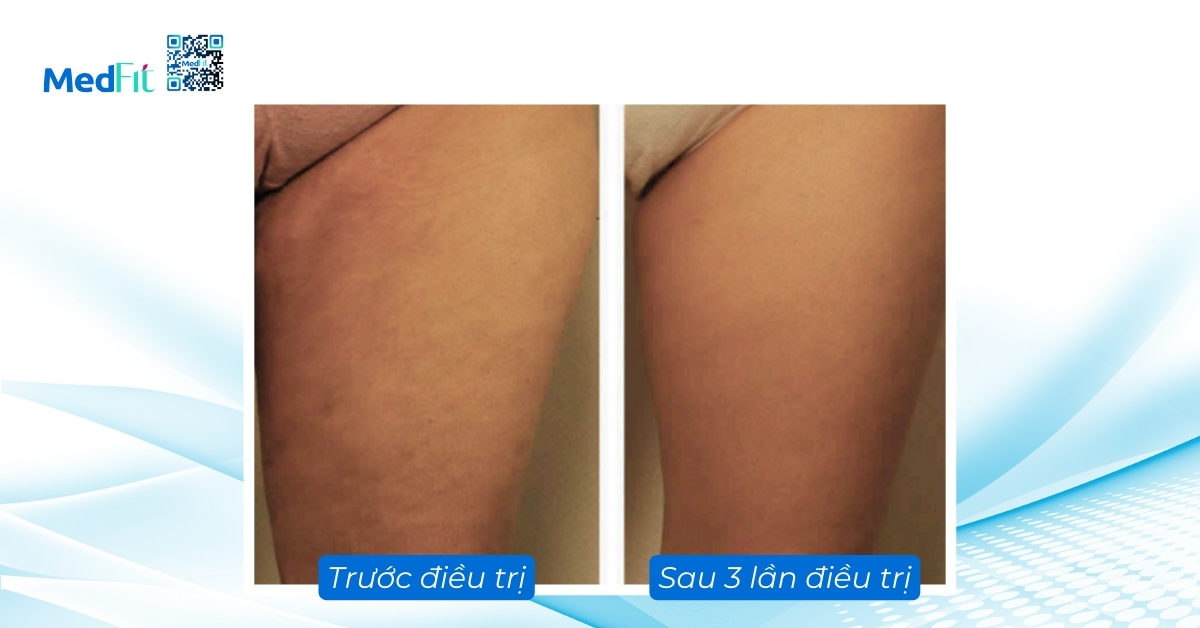 hiệu quả điều trị da sần vỏ cam của exilis