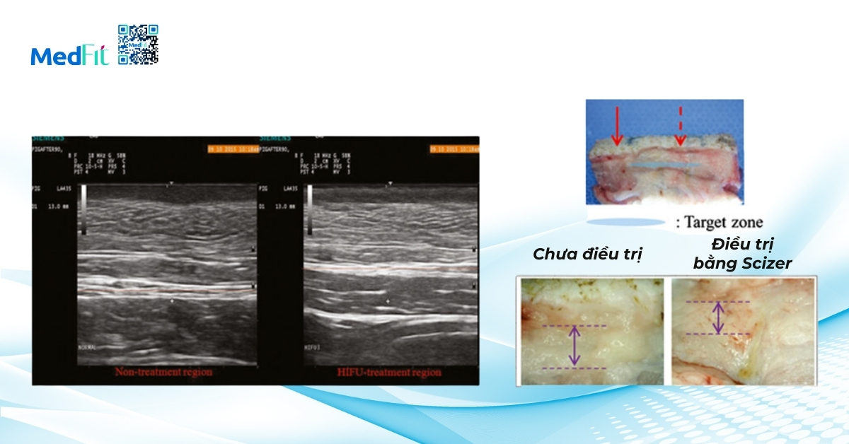 hiệu quả giảm độ dày lớp mỡ sau khi điều trị bằng scizer