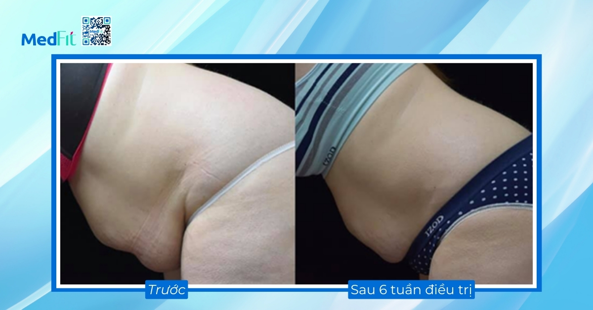 hiệu quả giảm mỡ bằng ultraslim ánh sáng đỏ