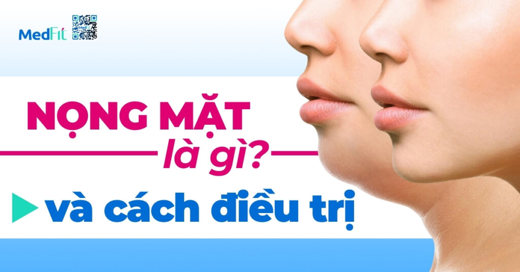 nọng mặt là gì và cách điều trị