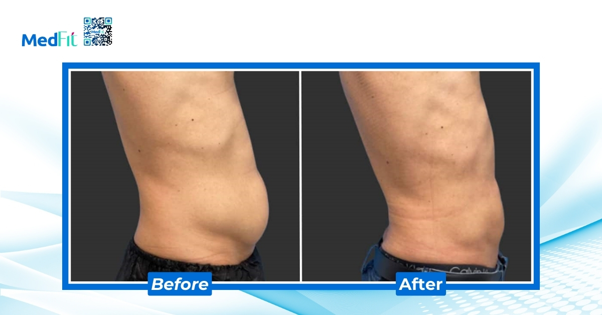 Phương pháp quang đông hủy mỡ có thực sự an toàn? 6 điều trị pah bằng hút mỡ hỗ trợ laser smartlipo™