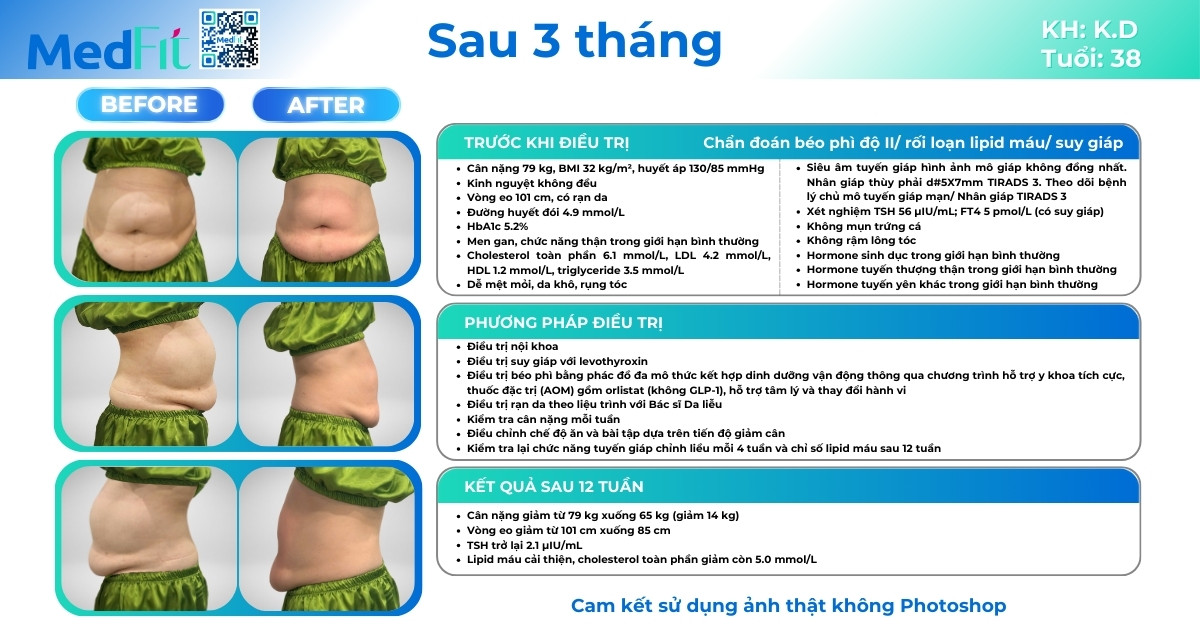 ca lâm sàng giảm cân thành công tại medfit (ca1)