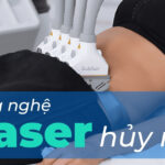 Công nghệ laser hủy mỡ