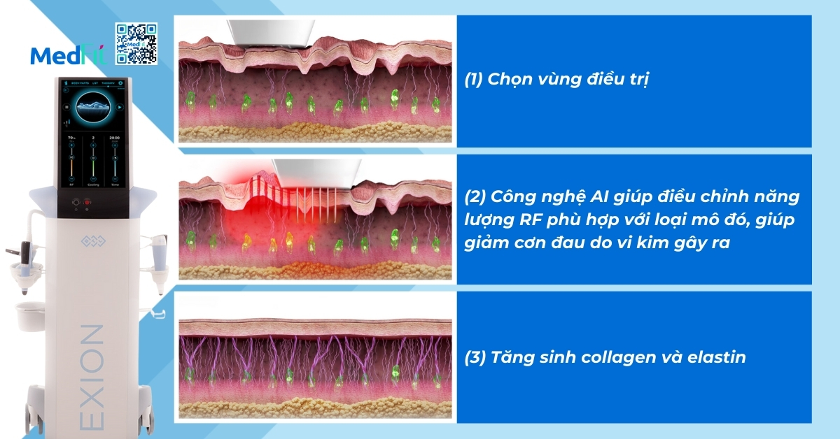 cơ chế của exion™ fractional rf