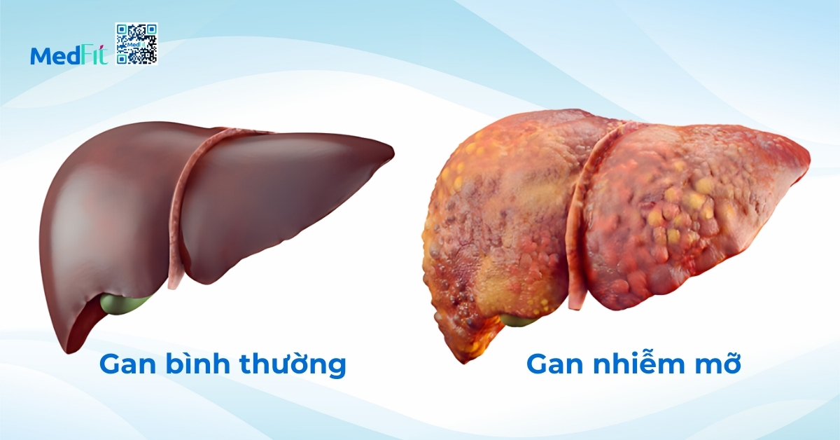 béo phì có thể dẫn đến sự tích tụ mỡ trong gan (hình minh họa)