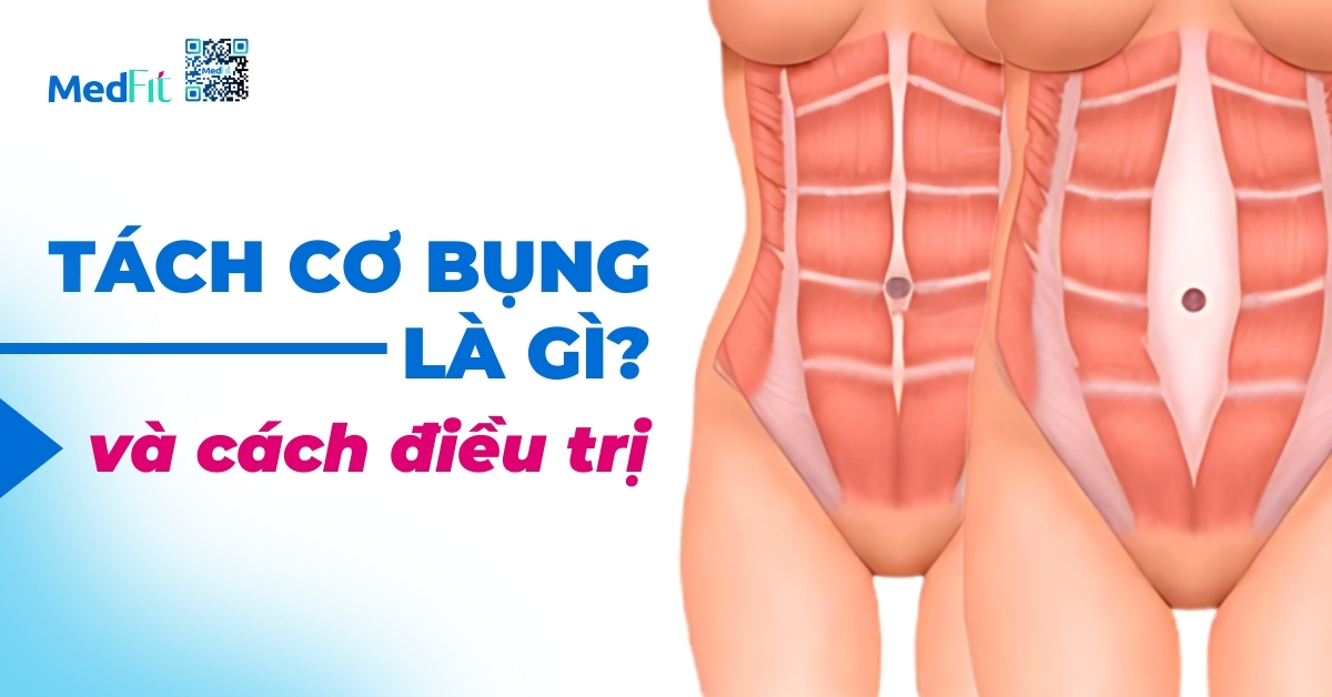 tách cơ bụng là gì và cách điều trị