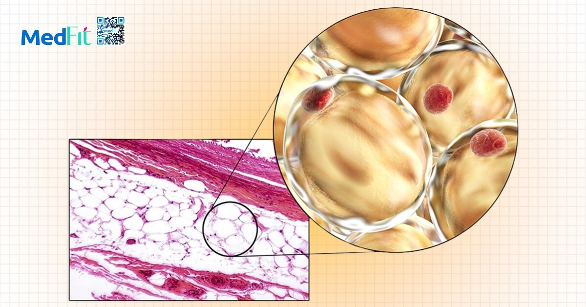 người béo phì có nhiều acid béo tự do trong máu, góp phần làm tăng ldl cholesterol và triglyceride