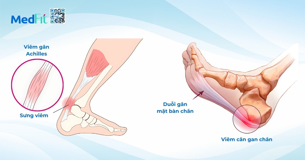 hình minh họa viêm gân achilles (bên trái) và viêm cân gan chân (bên phải)