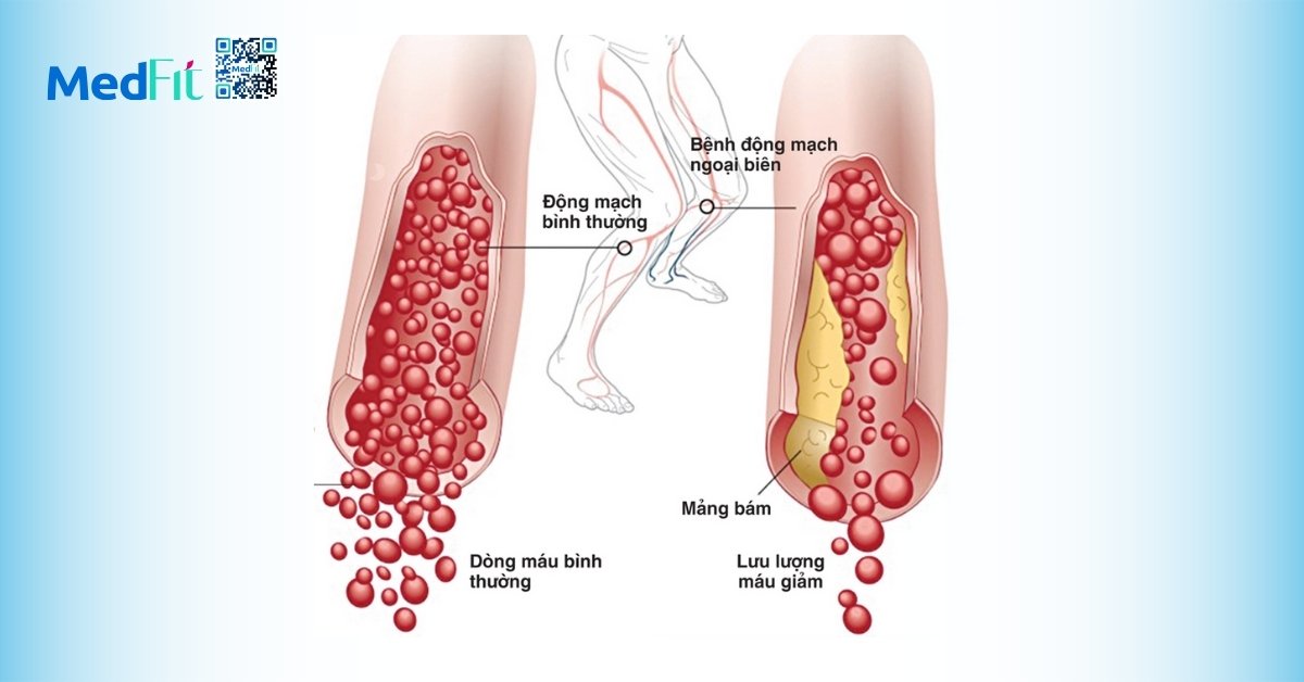 bệnh động mạch ngoại biên (hình minh họa)