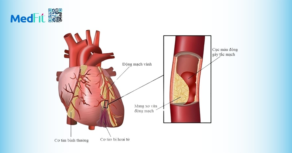 bệnh động mạch vành (hình minh họa)