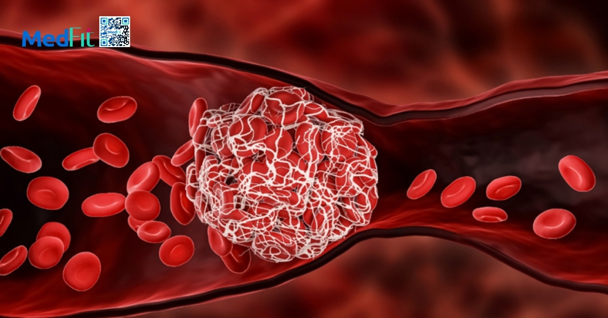 ldl cholesterol có thể dẫn đến đột quỵ do hình thành cục máu đông trong mạch máu (hình minh họa)