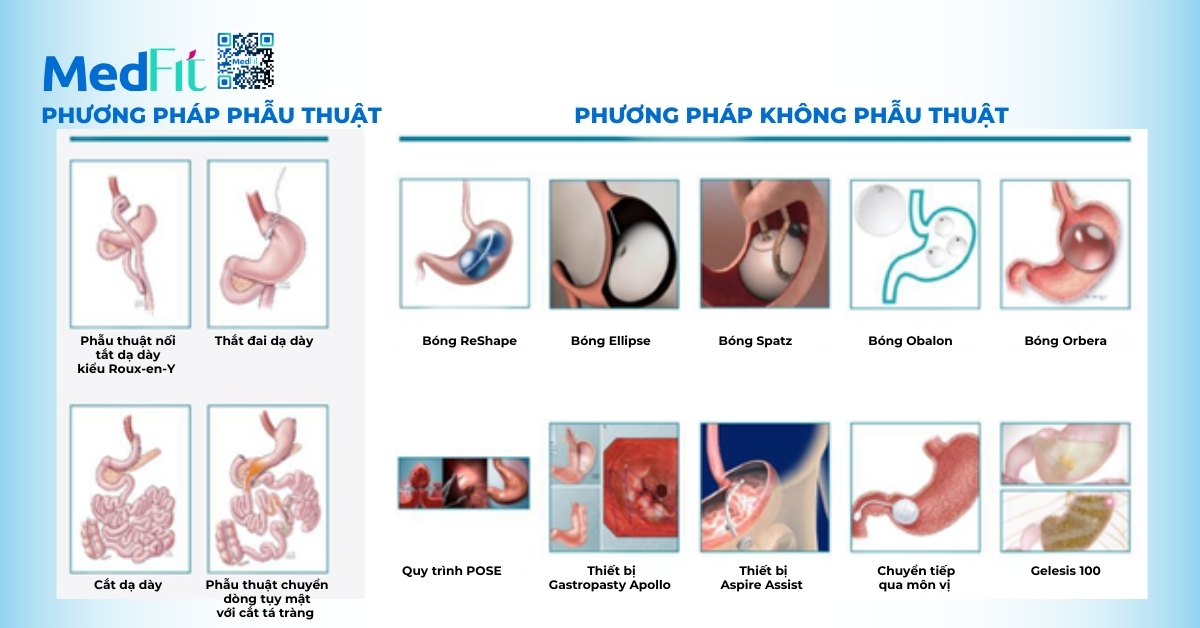 Điều trị béo phì xâm lấn