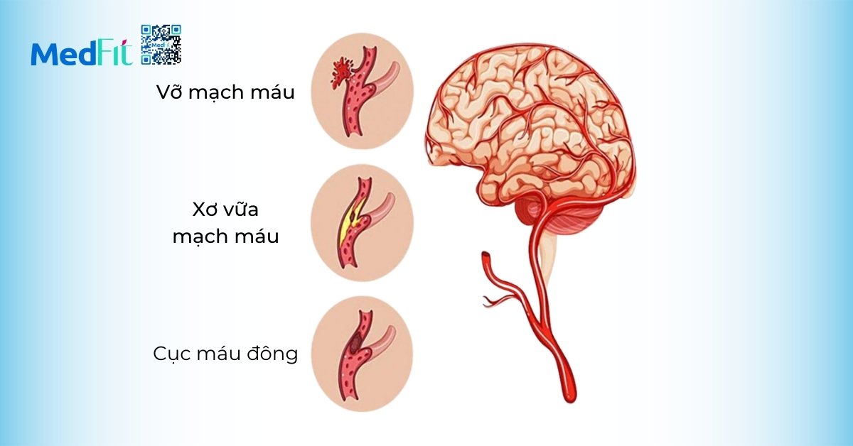 các nguyên nhân gây đột quỵ (hình minh họa)