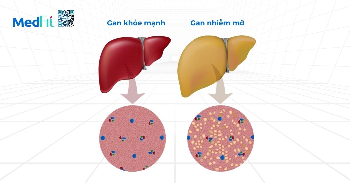 hình minh họa gan bình thường (bên trái) và gan nhiễm mỡ (bên phải)