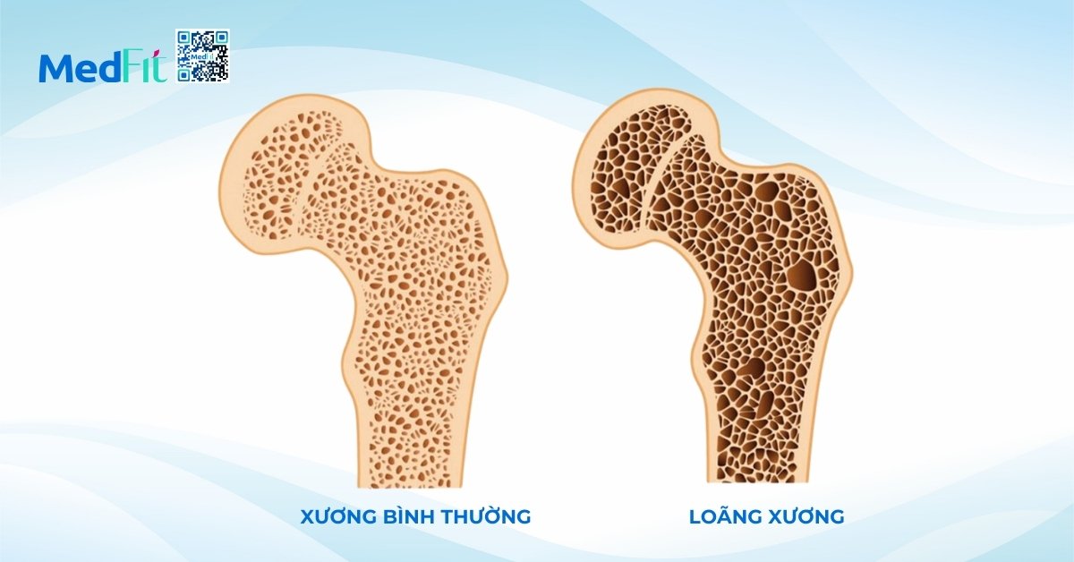 hình minh họa xương bình thường (bên trái) và loãng xương (bên phải)