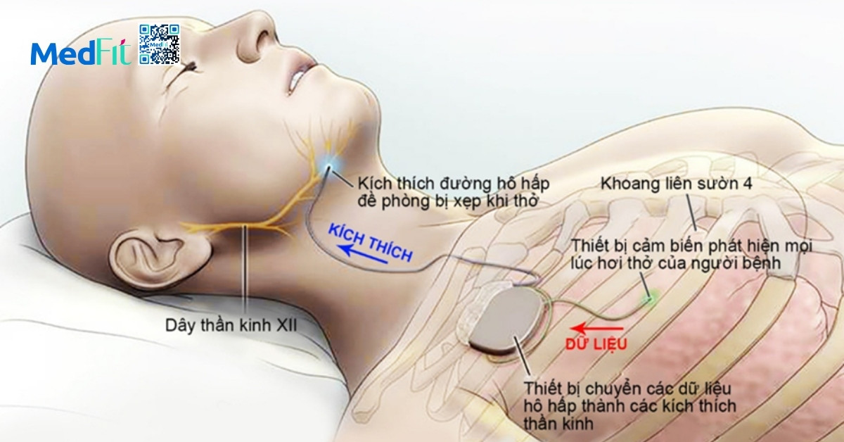 phương pháp kích thích thần kinh hạ thiệt (hình minh họa)