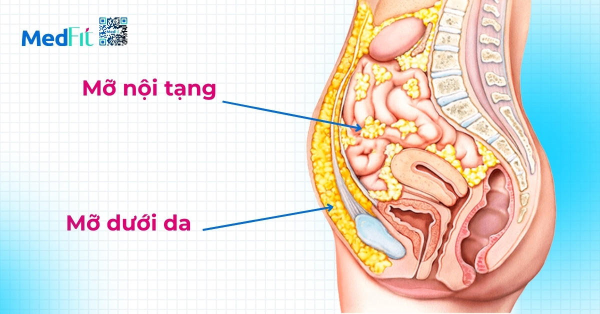 mỡ nội tạng liên quan tới tình trạng viêm mạn tính và rối loạn chuyển hóa