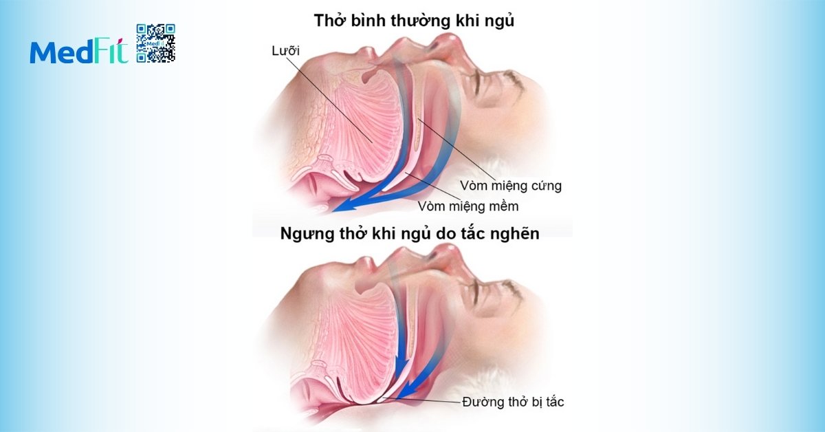 hội chứng ngưng thở khi ngủ do tắc nghẽn (hình minh họa)