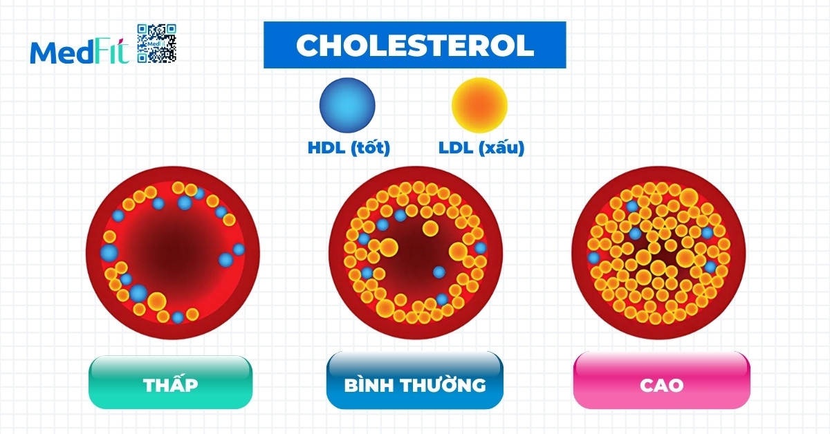 béo phì làm tăng ldl cholesterol và giảm hdl cholesterol