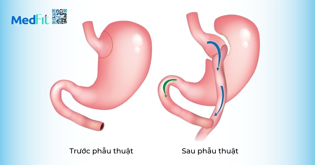 phẫu thuật nối tắt dạ dày (hình minh họa)