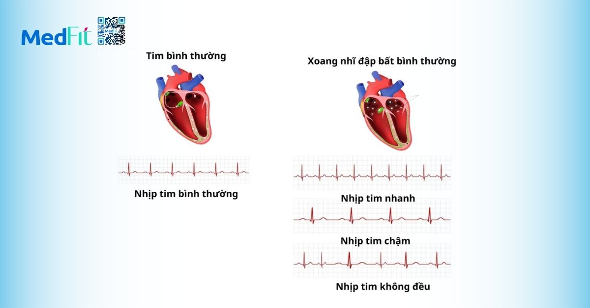 rối loạn nhịp tim (hình minh họa)