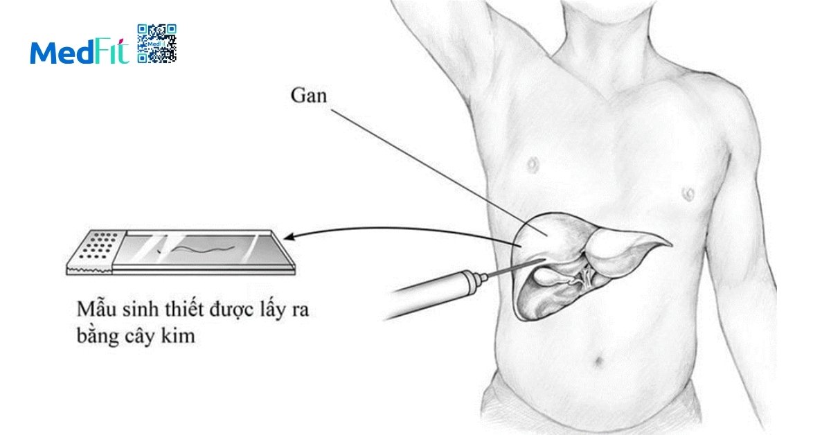 phương pháp sinh thiết gan (hình minh họa)