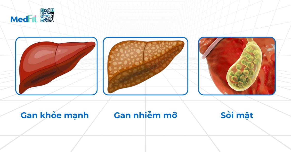 hình minh họa gan khỏe mạnh (hình 1), gan nhiễm mỡ (hình 2) và sỏi mật (hình 3)