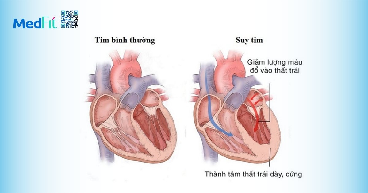 suy tim (hình minh họa)