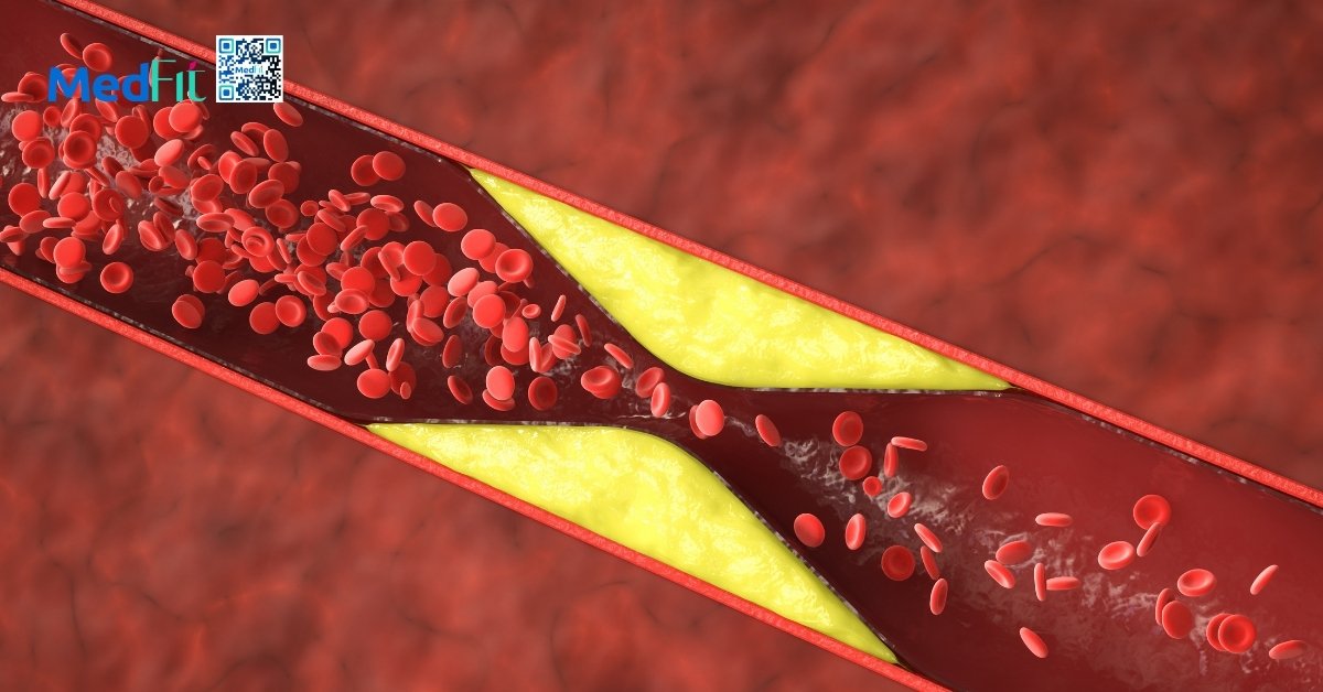 tăng cholesterol xấu làm tích tụ mảng bám trong lòng động mạch