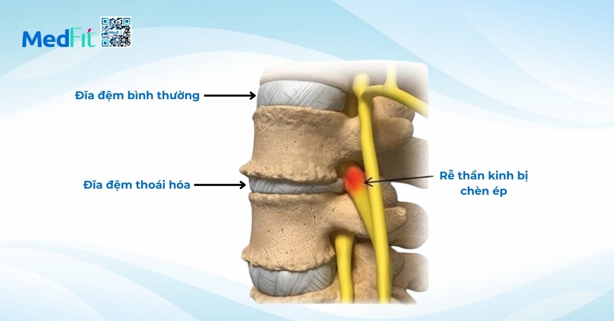 thoái hóa cột sống thắt lưng (hình minh họa)