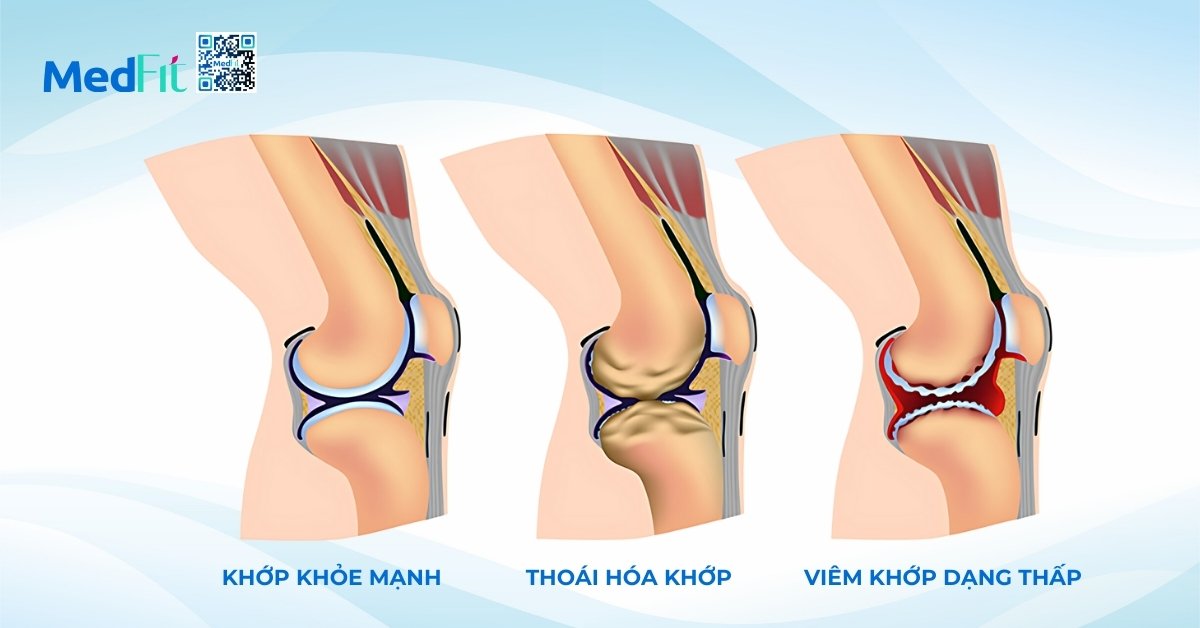 hình minh họa khớp khỏe mạnh, thoái hóa khớp và viêm khớp dạng thấp