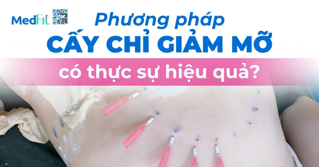 Phương pháp cấy chỉ giảm mỡ có thực sự hiệu quả?