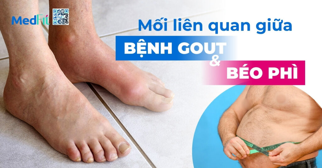 mối liên quan giữa bệnh gout và béo phì