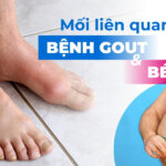 Mối liên quan giữa bệnh gout và béo phì