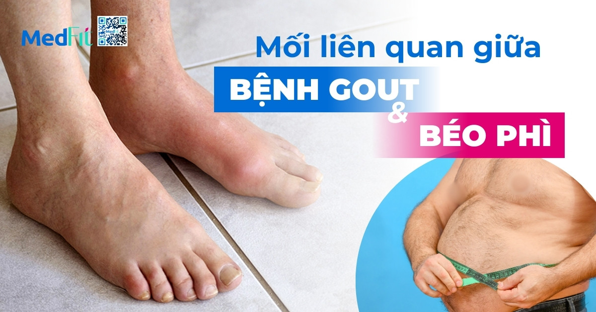 Mối liên quan giữa bệnh gout và béo phì