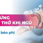 Hội chứng ngưng thở khi ngủ ở người thừa cân béo phì