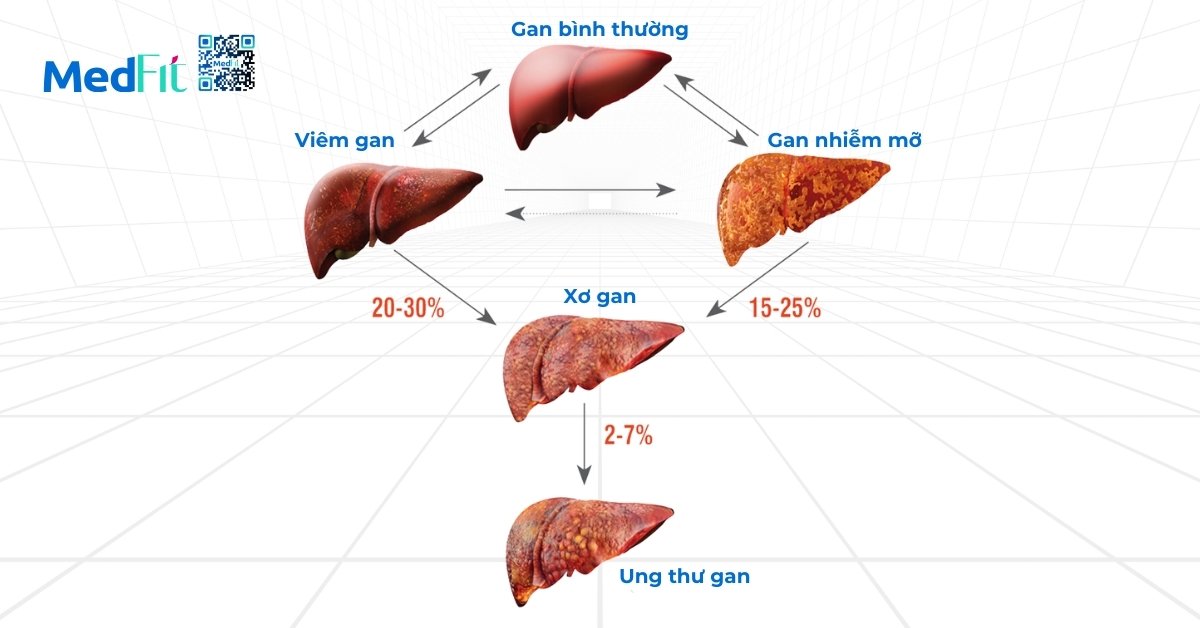 diễn tiến của bệnh gan theo từng giai đoạn (hình minh họa)