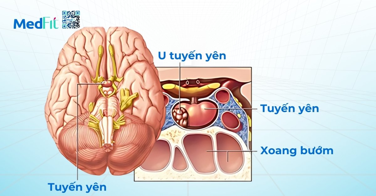 tình trạng u tuyến yên (hình minh họa)