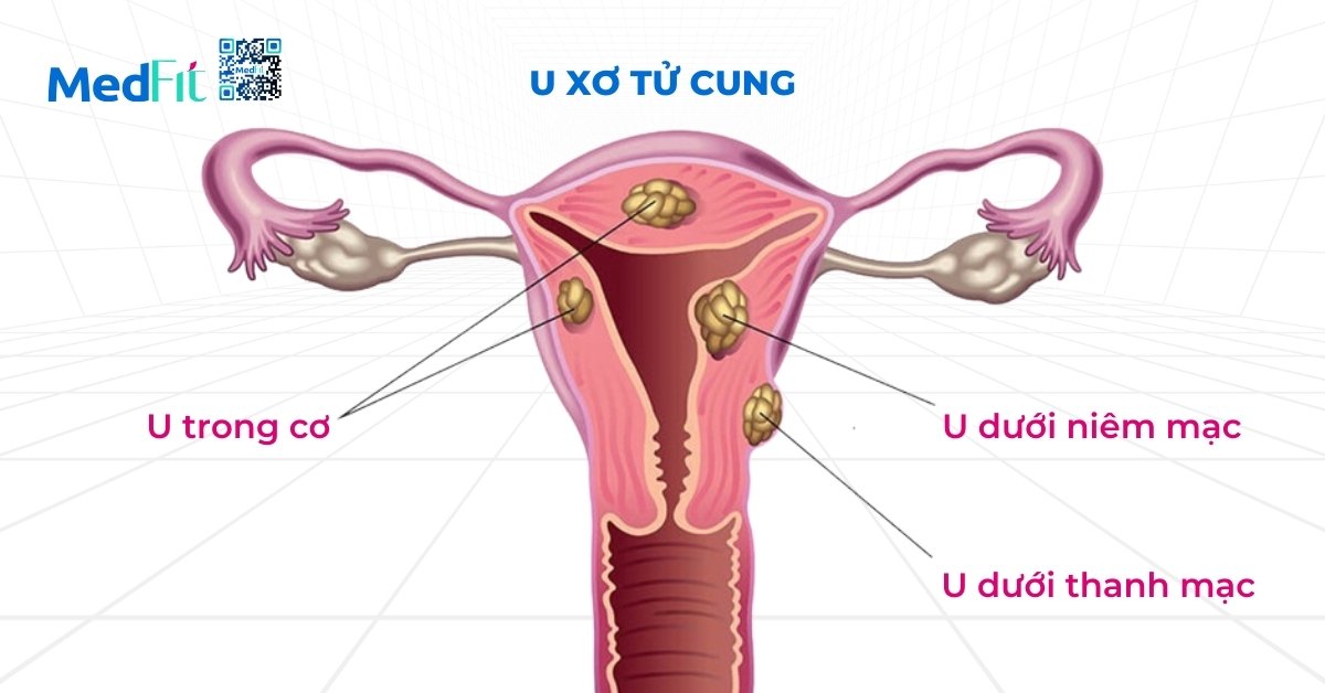 bệnh lý u xơ tử cung (hình minh họa)