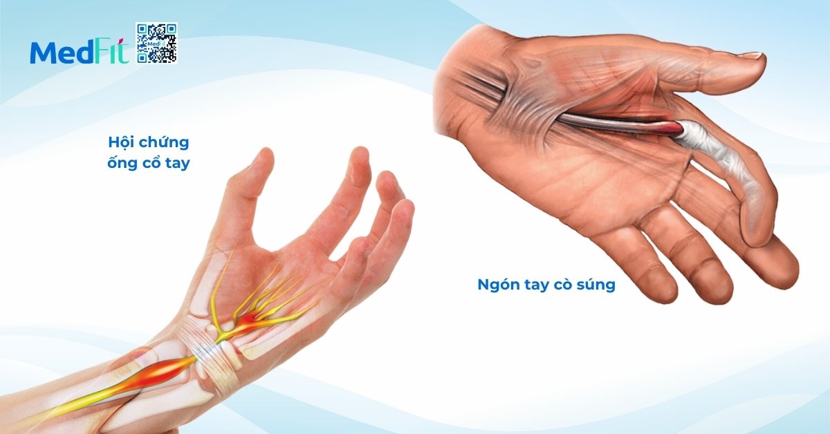 hình minh họa hội chứng ống cổ tay (bên trái) và ngón tay cò súng (bên phải)