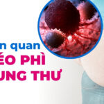 Mối liên quan giữa béo phì và ung thư