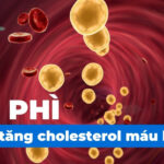 Béo phì có làm tăng cholesterol máu không?