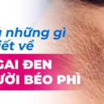 Tất cả những gì cần biết về dấu gai đen ở người béo phì