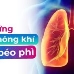 Hội chứng giảm thông khí ở người béo phì