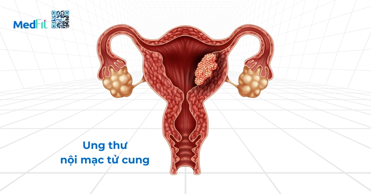 ung thư nội mạc tử cung (hình minh họa)