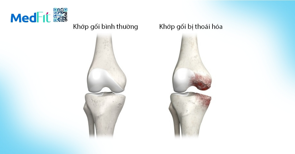 Khớp gối bình thường và thoái hóa khớp