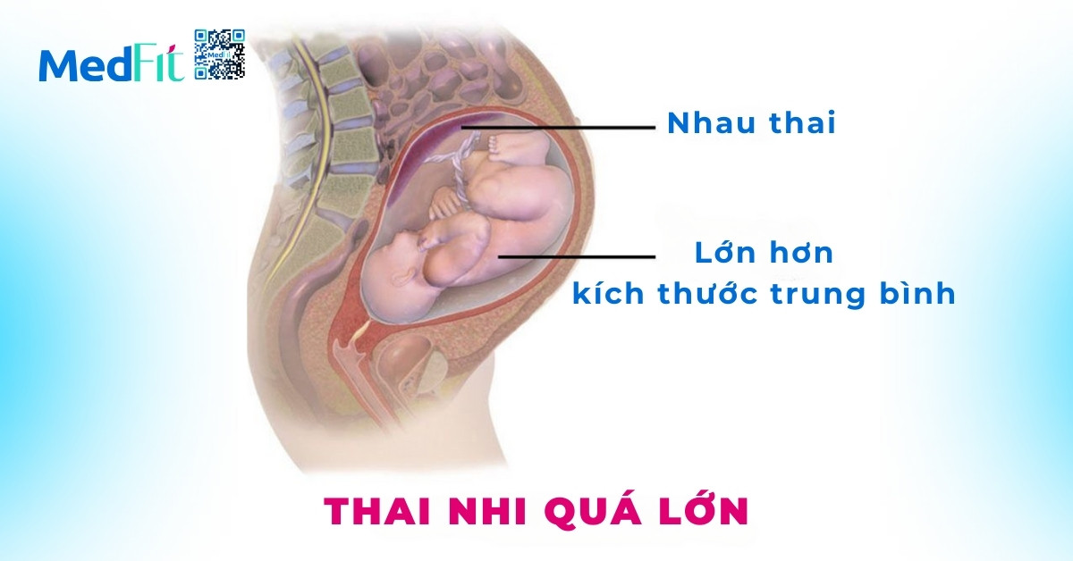 Nguy cơ thai nhi quá lớn