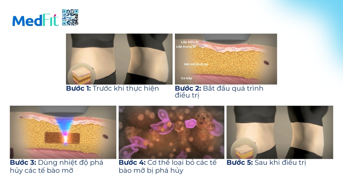 Nguyên lí hoạt động của liposonix